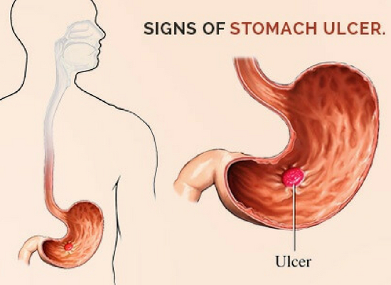 stomach ulcers
