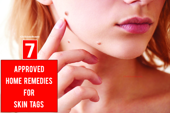 Approved Home Remedies For Skin Tags – Girlicious Beauty