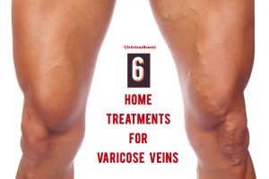 VARICOSE VEINS