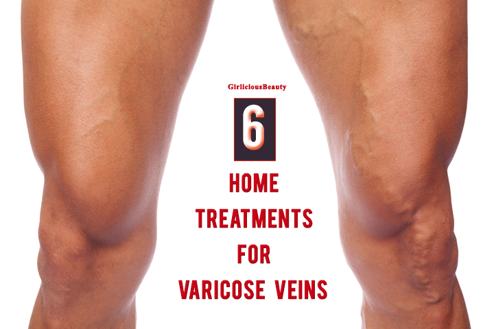 6 Home Treatments For Varicose Veins That Really Work