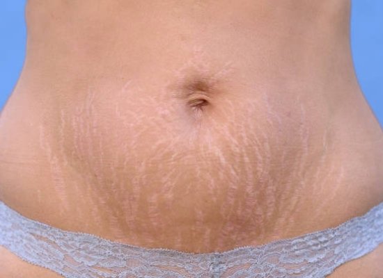 White stretch marks