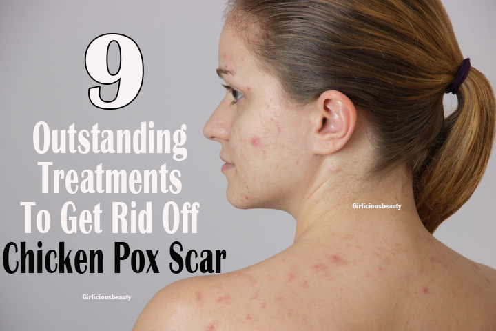 9 Outstanding Treatments To Get Rid Off Chicken Pox Scar