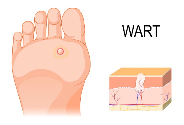 Frequently Asked Questions Regarding Plantar Warts Removal