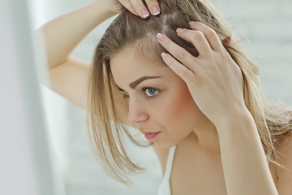 What to Know About Treating Alopecia Areata ?>