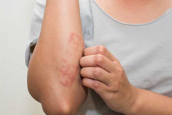 How to Get Rid of Eczema ?>