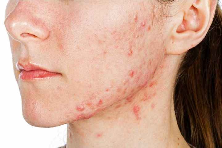 How to Maintain Acne Prone Skin?