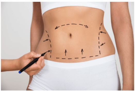 BodyTite Remains the Gold Standard of Liposuction After 10 Years