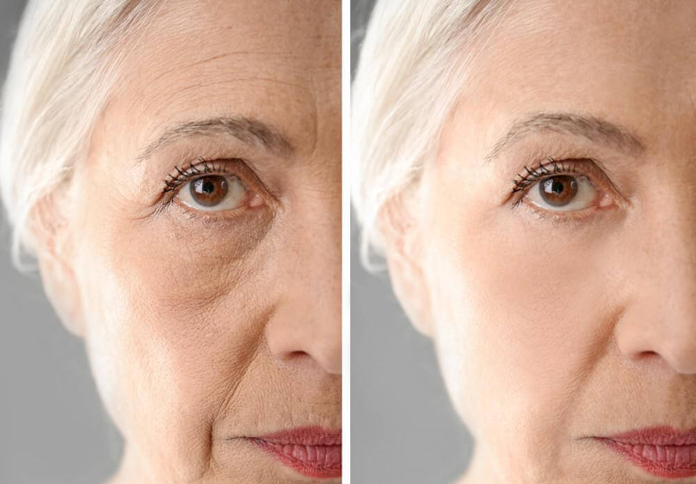 Is Fat Transfer the Future of Anti Aging?