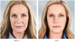 Liquid Facelift