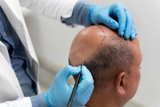 Considering a Hair Transplant? Read before you go for it.