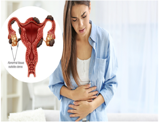 Endometriosis-Symptoms And Treatment.
