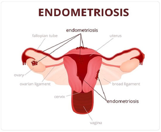 Endometriosis1