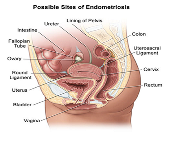 Endometriosis2