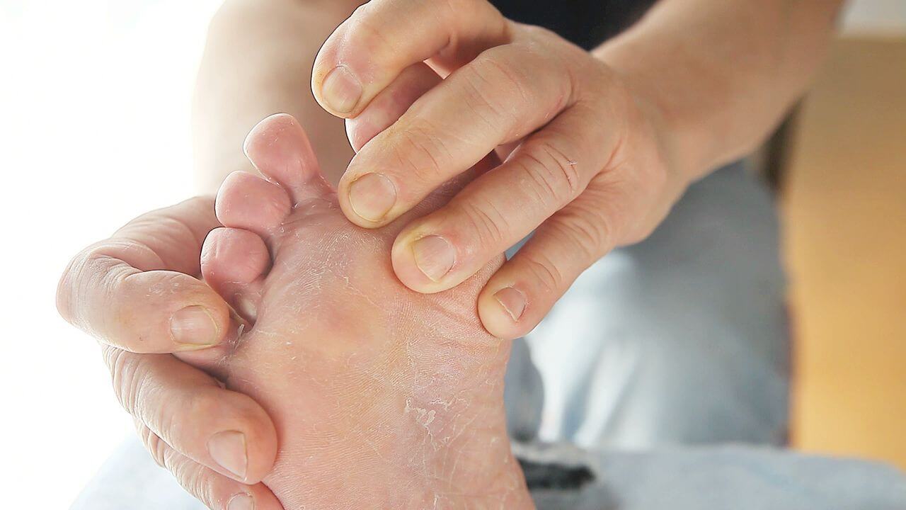 Stages of Diabetic Feet