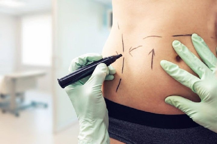 Choosing a Mini Tummy Tuck for Body Contouring