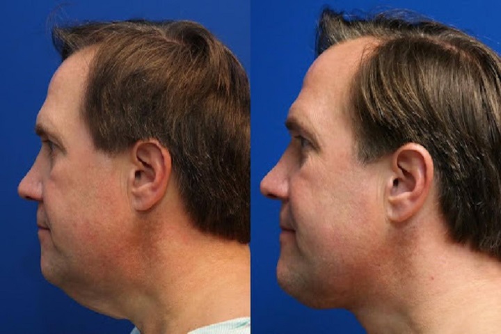 Tips for Minimizing the Appearance of Deep Plane Facelift Scars ?>