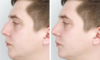 Exploring the Power of Nose Tip Surgery in Shaping Your Nose