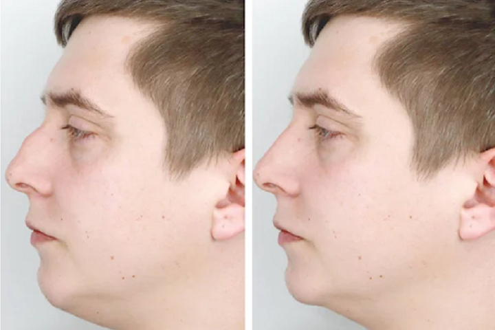 Exploring the Power of Nose Tip Surgery in Shaping Your Nose